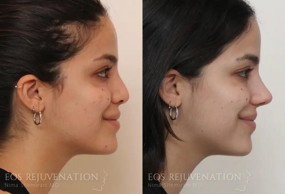 Revision rhinoplasty before and after — Patient 03, profile view. Actual patient of Dr. Nima Shemirani. Individual results may vary.