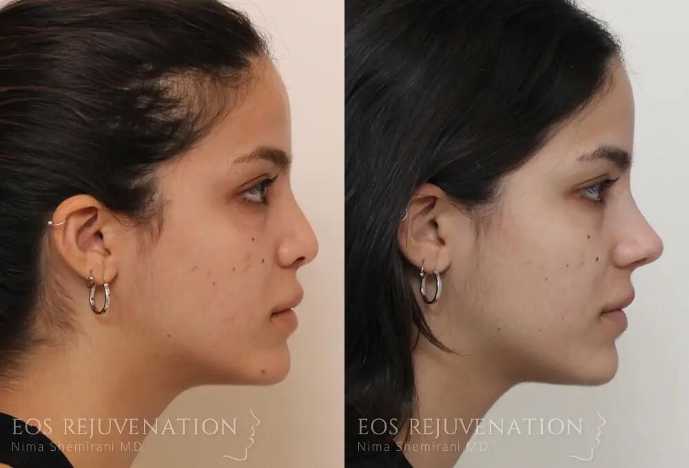 Revision rhinoplasty before and after — Patient 03, side profile view. Actual patient of Dr. Nima Shemirani. Individual results may vary.