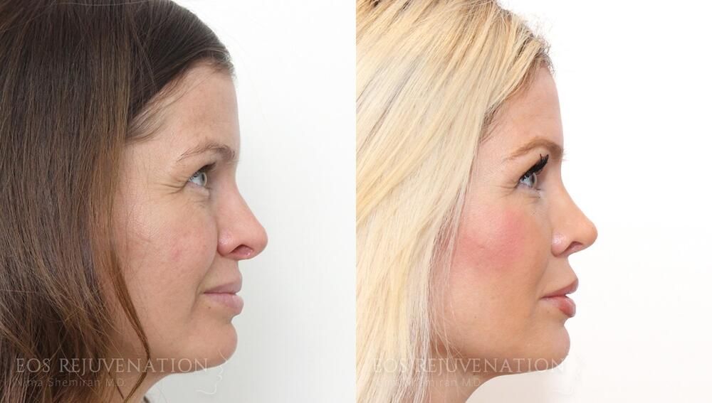 Revision rhinoplasty before and after — Patient 07, profile view. Actual patient of Dr. Nima Shemirani. Individual results may vary.